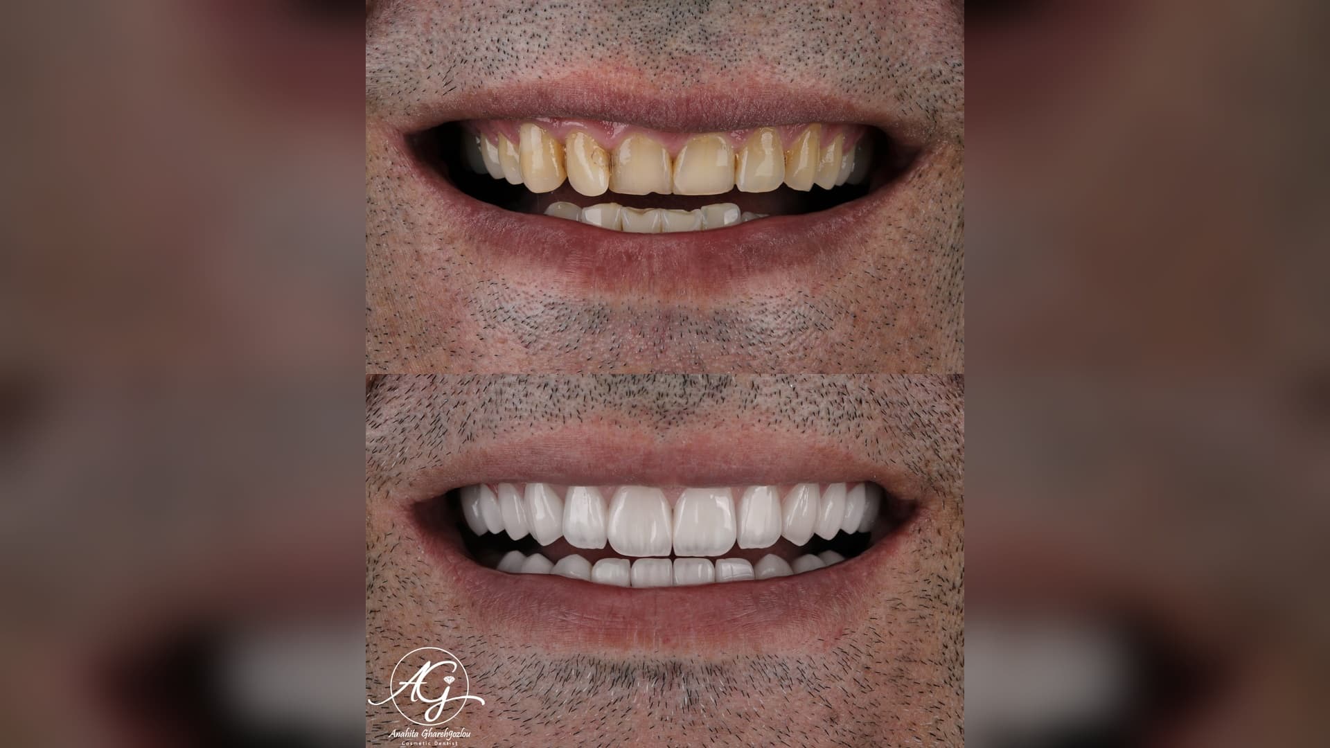 تصویر قبل و بعد کاندید لمینت سرامیکی ایمکس