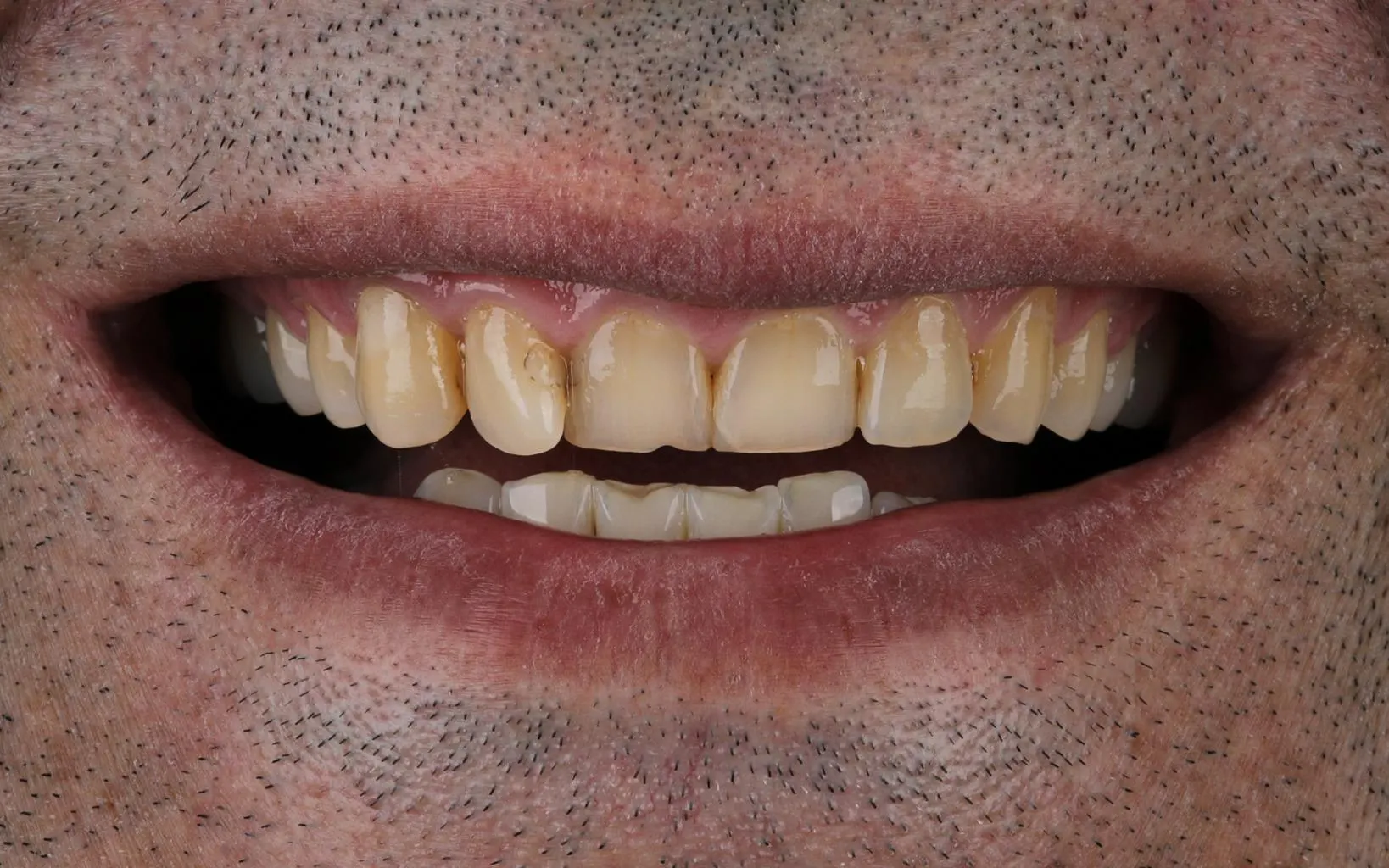 نمونه لمینت سرامیکی