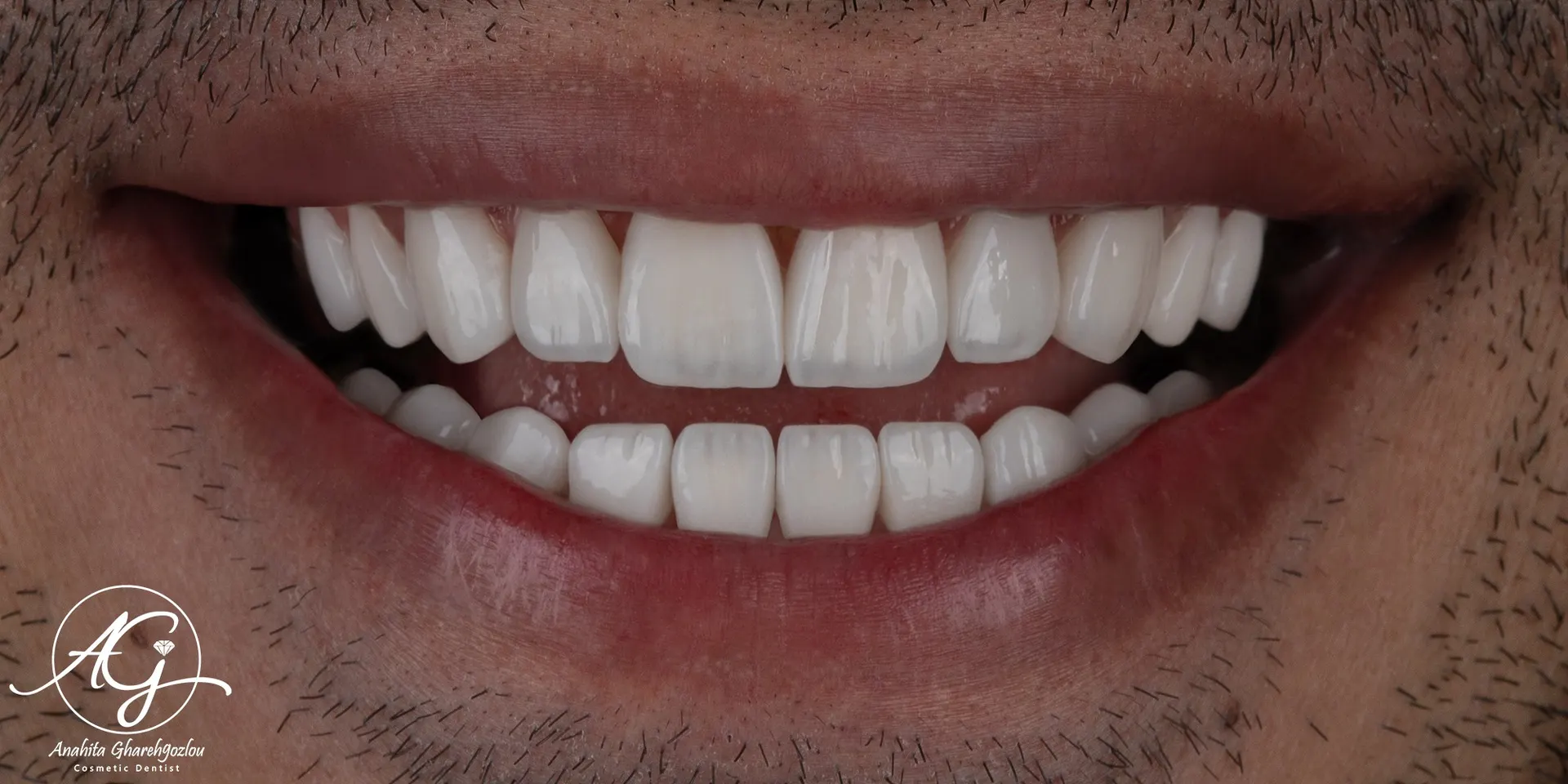 نمونه لمینت سرامیکی