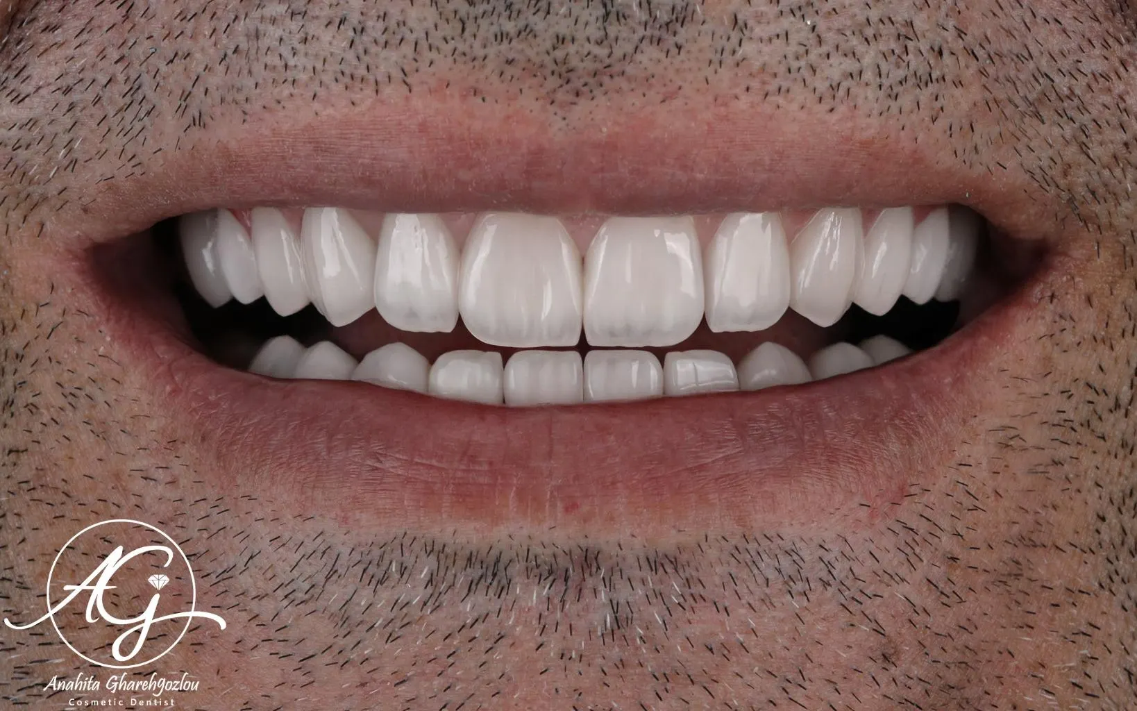 نمونه لمینت سرامیکی — قبل