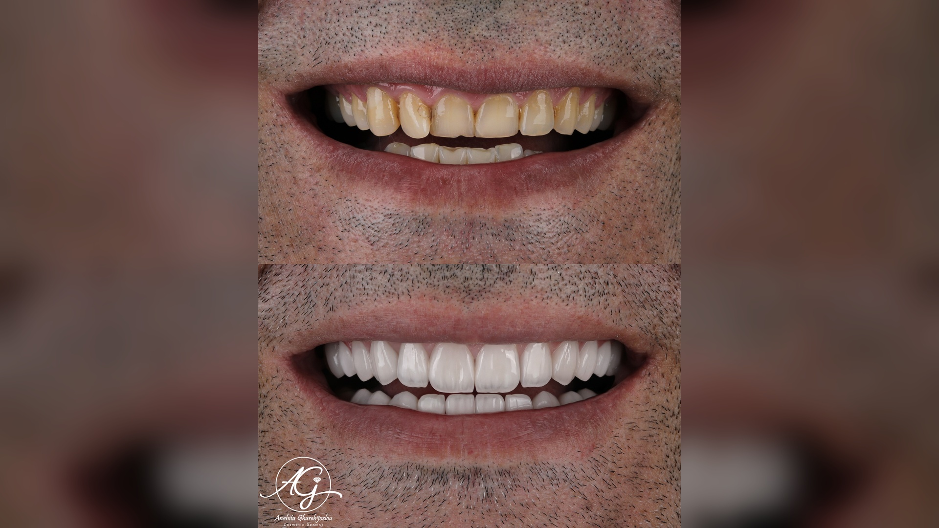 تصویر قبل و بعد کاندید لمینت سرامیکی ایمکس
